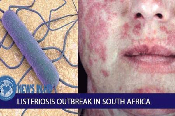 2018 Listeriosis Outbreak in South Africa.